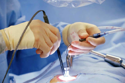 Endoscopic Spine Surgery