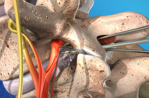 Lumbar Microdiscectomy